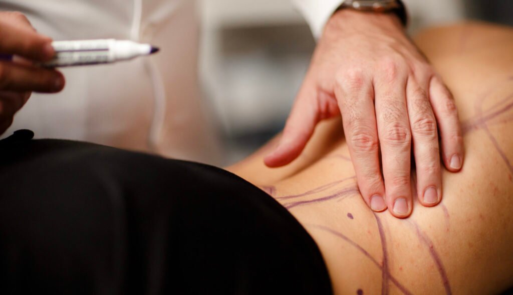 abdominoplastia