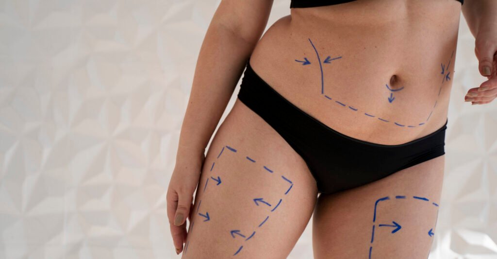 lipoaspiracao marcada